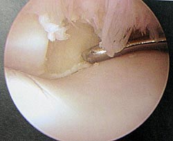 Fetlock Chip Arthroscopically Removed